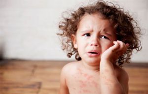 Вирусные заболевания у детей, сопровождающиеся сыпью